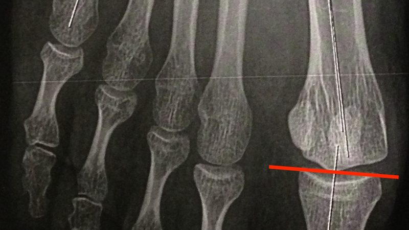 电瓶极柱腐蚀，如何有效处理？**